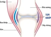 Thoái hóa khớp hay viêm khớp dạng thấp?