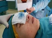 Mũi hoại tử xanh lè do dùng chỉ khâu da để nâng mũi
