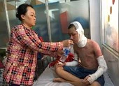 Hai học sinh bị bỏng cồn nặng khi đang học thí nghiệm 