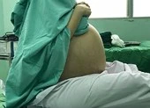 Cô gái mang khối u khổng lồ 18kg nhàm là béo bụng