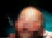 Bé 3 tuổi bị chó cắn tổn thương nghiêm trọng vùng mặt