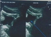 Tự lấy sỏi thận qua đường niệu bằng… cọng cỏ