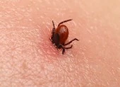 Liệt, mất trí nhớ vì bị ve cắn 16 năm trước