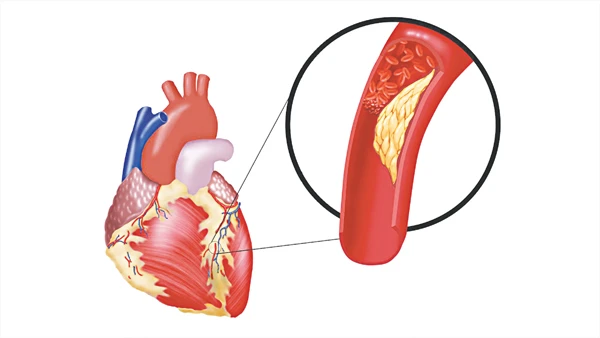 Ai dễ mắc máu nhiễm mỡ? ảnh 1