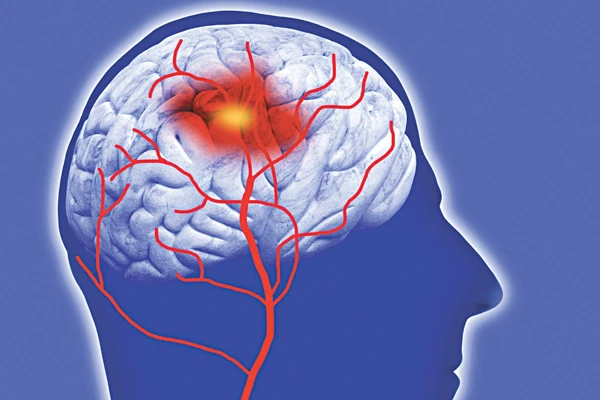 Ai dễ mắc máu nhiễm mỡ? ảnh 2
