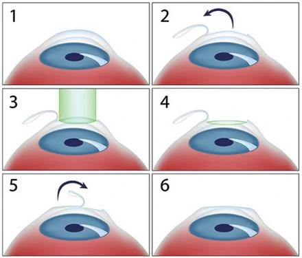 Có nên phẫu thuật chữa cận thị? ảnh 1