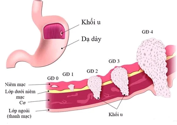 Các loại ung thư khó phát hiện sớm ảnh 1 Các loại ung thư khó phát hiện sớm ảnh 1