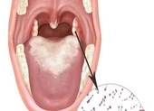 5 khuyến cáo của Bộ Y tế phòng chống bệnh bạch hầu