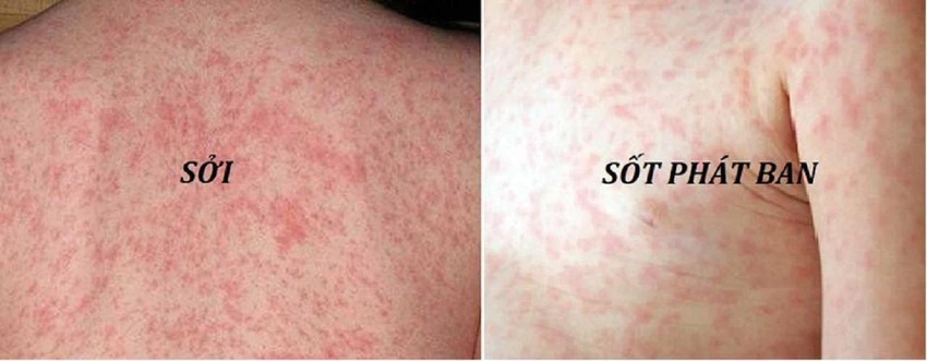 Sởi và sốt phát ban. Ảnh: Bệnh viện Thu Cúc