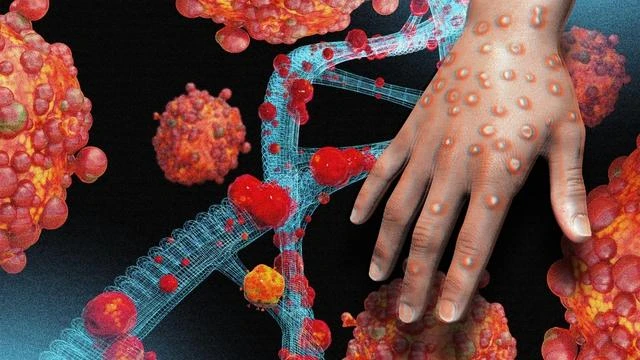 Một hình thái tổn thương do nhiễm virus đậu mùa khỉ (Monkeypox virus). Một hình thái tổn thương do nhiễm virus đậu mùa khỉ (Monkeypox virus).