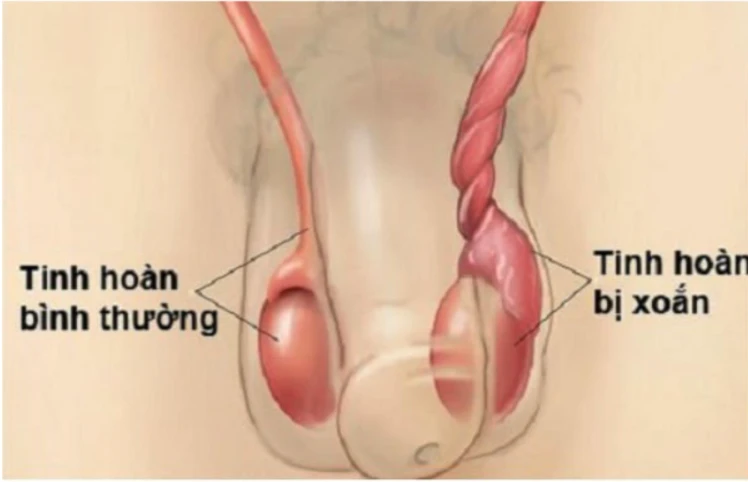 tinh hoàn bình thường và bị xoắn