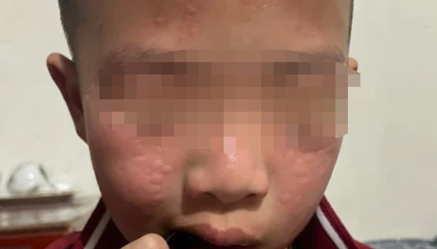 Nhiều học sinh có biểu hiện sưng mắt, dị ứng sau khi nhà trường phun thuốc diệt muỗi