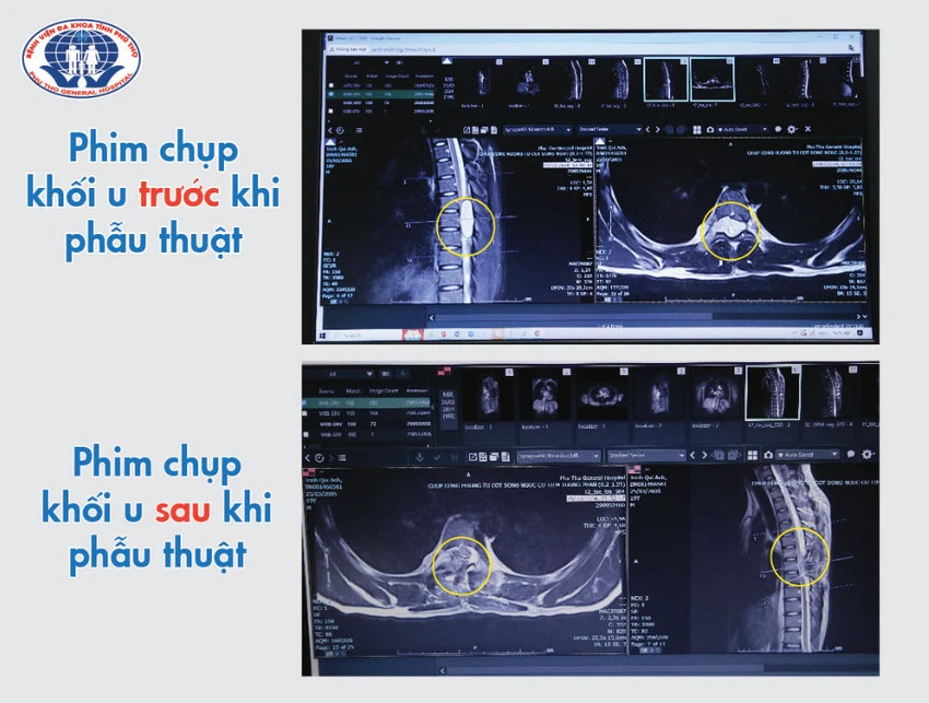 phim chụp u tủy