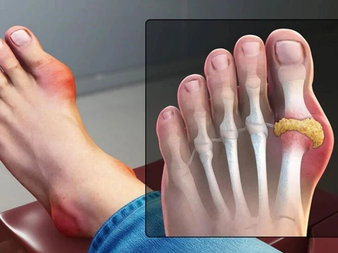 Các khớp chân thường bị viêm đau do bệnh gút hơn so với các khớp tay