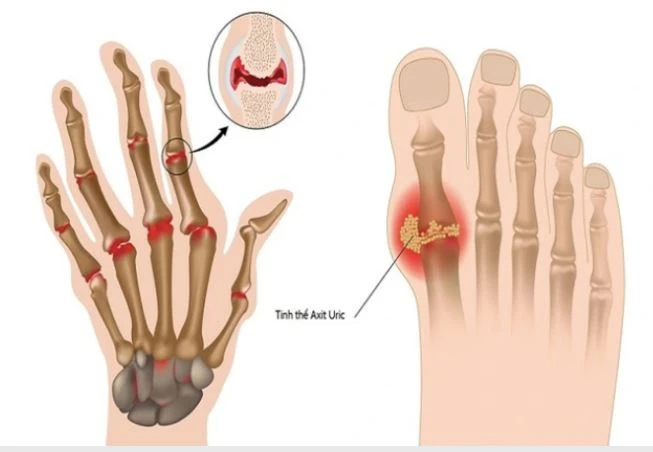 Nồng độ acid uric tăng trong máu là nguyên nhân hàng đầu gây ra bệnh gout.