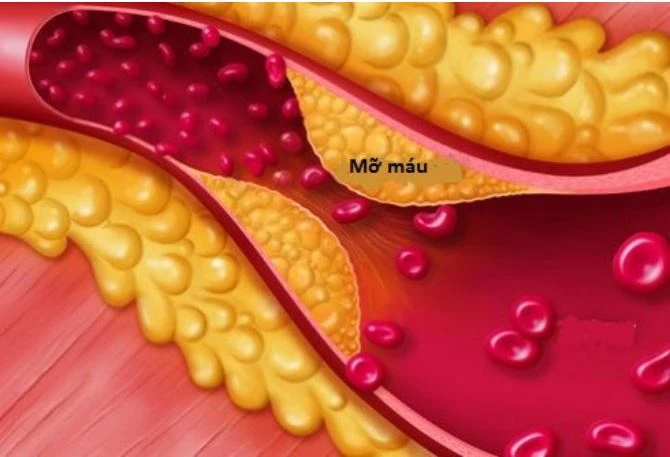 bệnh mỡ máu
