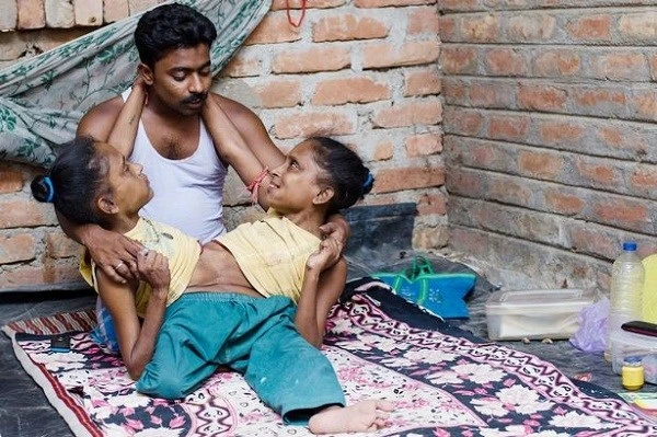 Hai chị em sinh đôi dính liền cùng yêu một người đàn ông ảnh 1 Hai chị em sinh đôi dính liền cùng yêu một người đàn ông ảnh 1