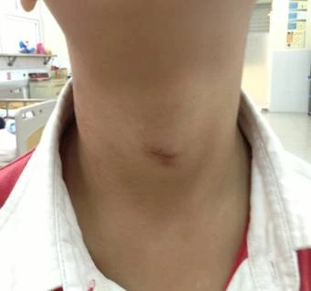 Vết thương trên cổ cháu do dây rèm cửa thít. Ảnh:Ngô Anh Vinh. cua-co-4912-1417491178.jpg