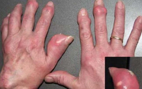 Bị bệnh gout nên ứng phó thế nào? ảnh 1 Bị bệnh gout nên ứng phó thế nào? ảnh 1