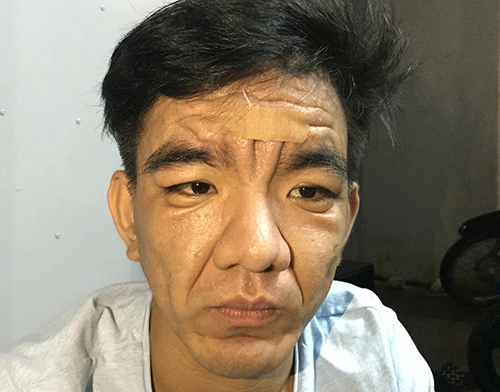 Gương mặt Nguyễn Hiếu Nghĩa 23 tuổi có nhiều nếp nhăn như tuổi lục tuần. Ảnh: PH chang-trai-23-tuoi-hoa-ong-gia-60
