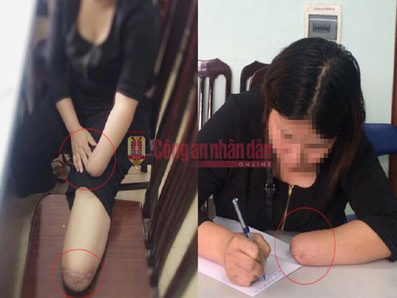 Chân và tay của chị N. đã bị chặt đứt. Ảnh: CAND