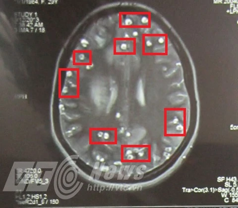 Những nốt tròn trong có nhân là nang sán lợn làm tổ dày đặc trong não chị H. (Ảnh: BS Thọ cung cấp) Ăn nem thính, tiết canh, bị sán lợn làm tổ dày đặc trong não