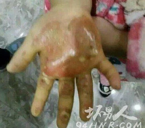 Mẹ đẻ nhúng tay con gái vào nước sôi, rắc muối vào vết thương ảnh 1 Mẹ đẻ nhúng tay con gái vào nước sôi, rắc muối vào vết thương ảnh 1