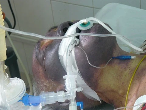 Cận cảnh gương mặt bị phá hủy do liên cầu lợn ảnh 1 Cận cảnh gương mặt bị phá hủy do liên cầu lợn ảnh 1
