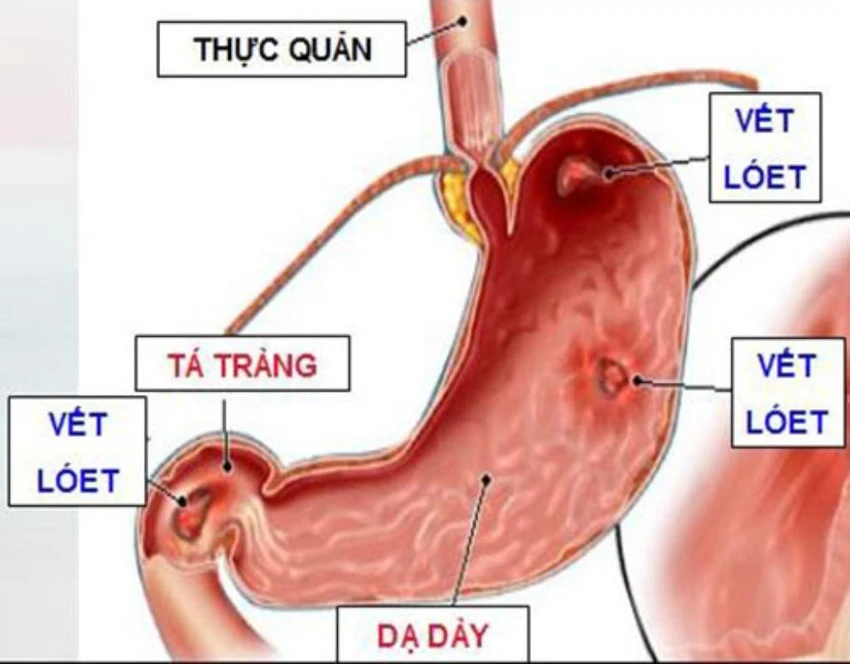 Hình ảnh dạ dày bị loét.