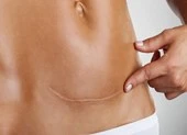 Bất ngờ vì thai làm tổ ở vết sẹo mổ cũ 
