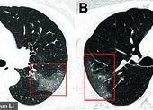 Thấy gì trong ảnh phổi của một bệnh nhân nhiễm virus Corona?