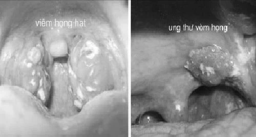 Cách phân biệt ung thư vòm họng và viêm họng ảnh 1