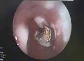 Ngủ dậy, phát hiện hàm răng giả đã 'chui tọt' vào phế quản
