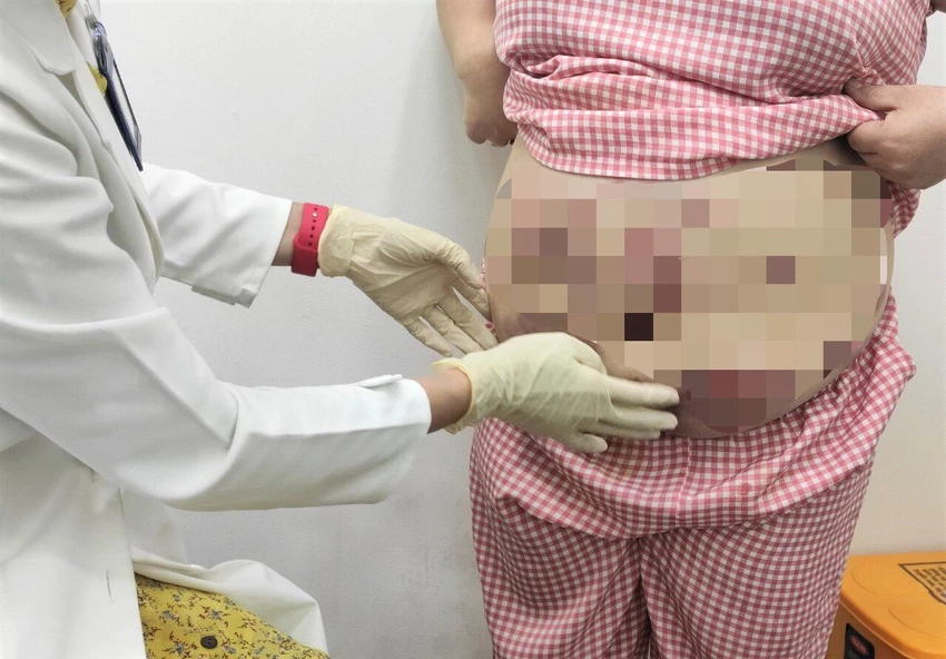 Bệnh nhân bị áp xe sau tiêm tan mỡ hai tháng. Ảnh: BVCC Bệnh nhân bị áp xe sau tiêm tan mỡ hai tháng. Ảnh: BVCC