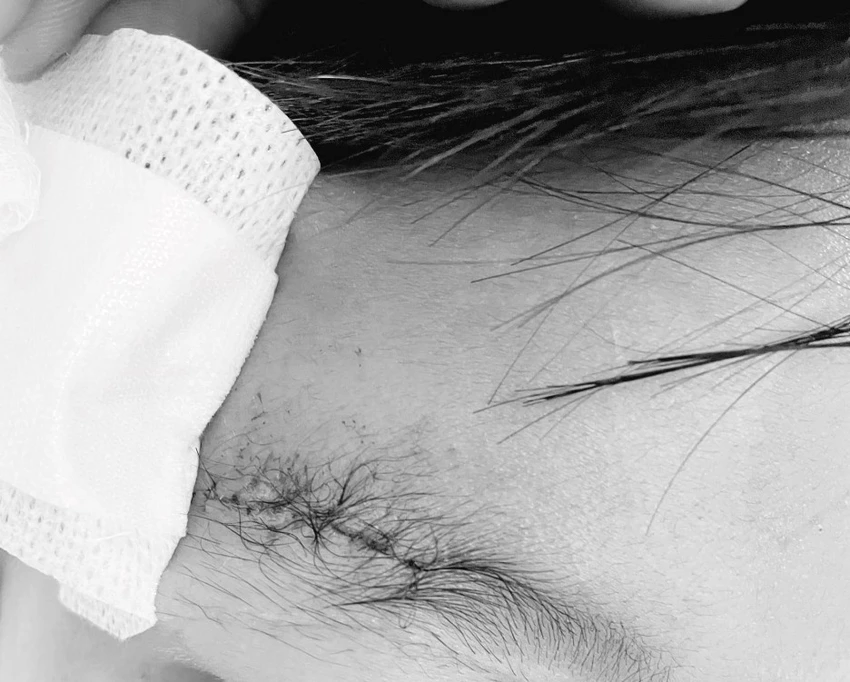 Viên đạn găm vào xương sọ ngay trên ổ mắt phải bé trai 10 tuổi. Ảnh: BVCC