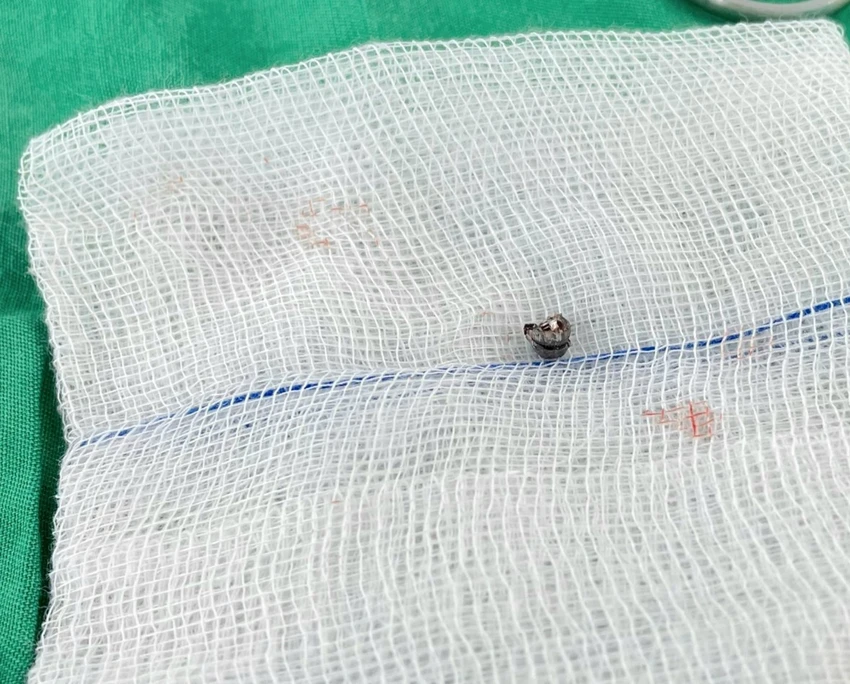Dị vật là viên đạn chì kích thước 5 mm. Ảnh: BVCC
