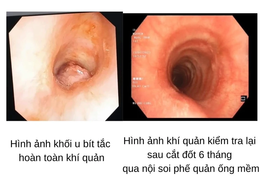 Hình ảnh khối u trước và sau cắt đốt. Ảnh: BVCC Hình ảnh khối u trước và sau cắt đốt. Ảnh: BVCC