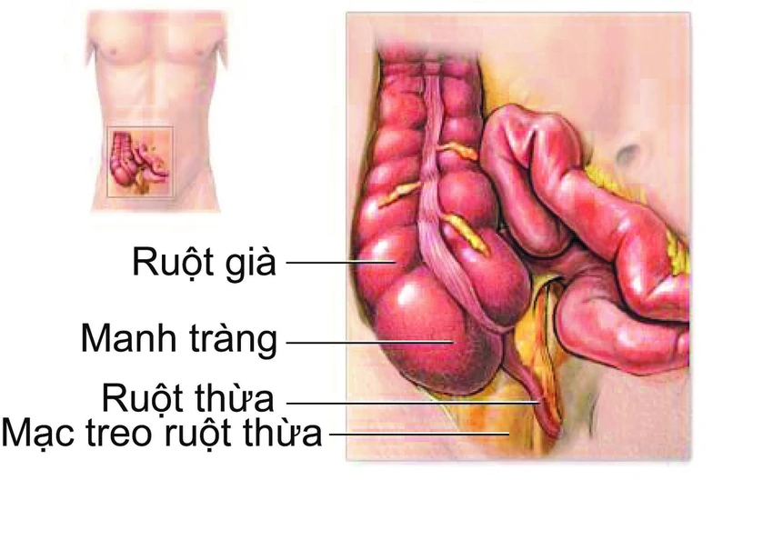 Có nhiều bệnh lý hơi giống với đau ruột thừa như viêm mủ vòi trứng, viêm túi thừa manh tràng, viêm hồi tràng. Ảnh: Internet