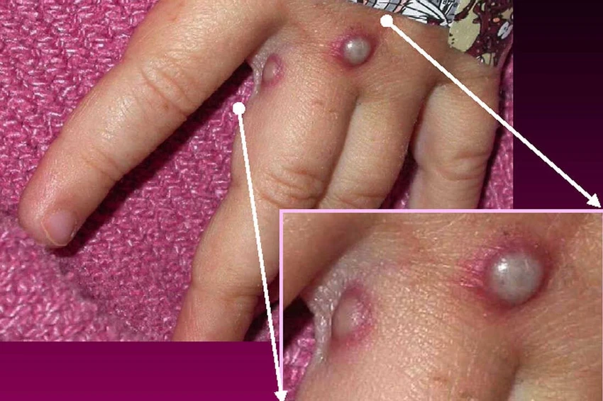 đậu mùa khỉ - 2