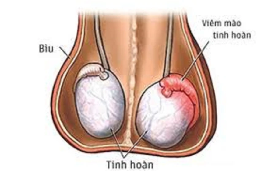Viêm mào tinh hoàn - 1