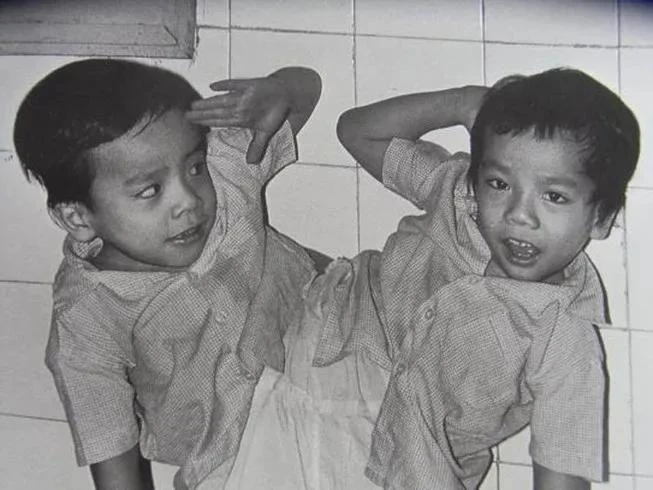 Cặp song sinh Việt - Đức