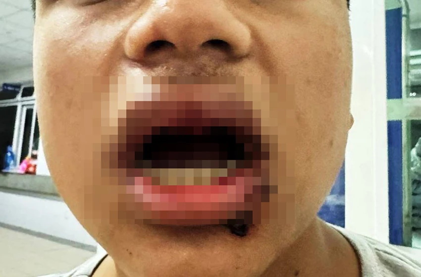 Nam sinh bị gãy 4 cái răng và đa chấn thương khác sau khi bị hành hung. Ảnh: Người thân cung cấp Nam sinh bị gãy 4 cái răng và đa chấn thương khác sau khi bị hành hung. Ảnh: Người thân cung cấp