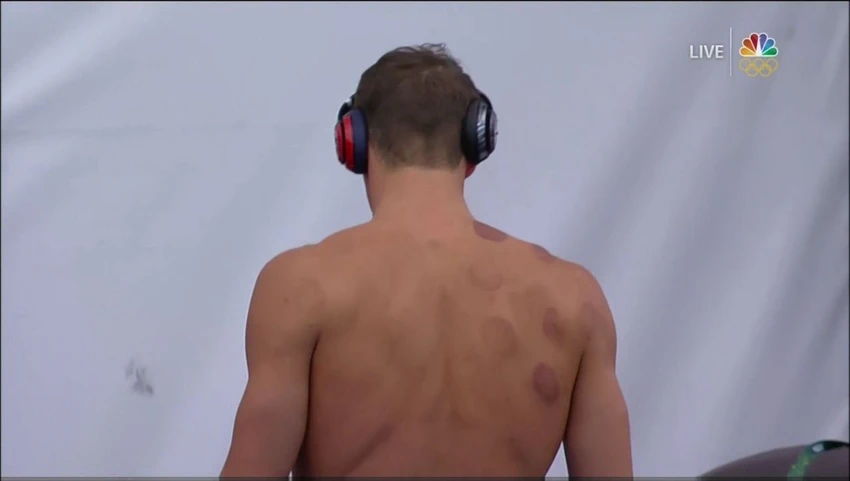 Dưới đây là một góc của lưng Phelps ', từ đêm chủ nhật: Phelps thêm giác đến thói quen phục hồi của mình dẫn đến Rio. Việc điều trị là đặc trưng trong một Olympic trước thương mại từ Under Armour.