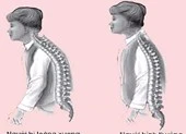 Tại sao dùng canxi đắt tiền vẫn bị loãng xương?