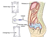 Bệnh thận mạn giai đoạn cuối không cần đến bệnh viện chạy thận