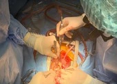 Cứu sống bệnh nhân bị u tim lớn tuổi nhất miền Tây