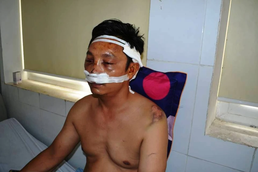 Chưa gắp được dị vật trong đầu nạn nhân bị bắn ảnh 1 Chưa gắp được dị vật trong đầu nạn nhân bị bắn ảnh 1