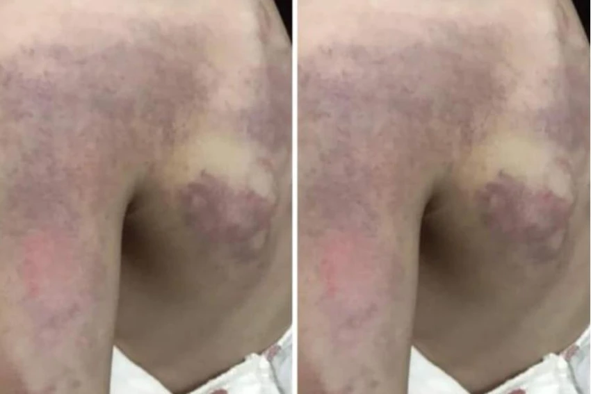 Hình ảnh người dân đăng lên mạng xã hội cho rằng em Ph bị cô giáo đánh vì không thuộc bài. Ảnh: ĐL Hình ảnh người dân đăng lên mạng xã hội cho rằng em Ph bị cô giáo đánh vì không thuộc bài. Ảnh: ĐL