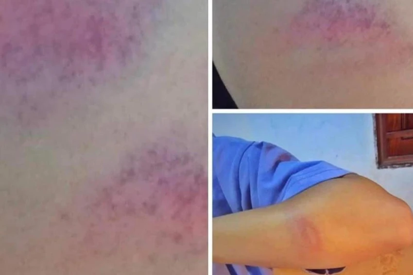 Hình ảnh vết thương trên tay nữ sinh được đăng trên mạng xã hội. Hình ảnh vết thương trên tay nữ sinh được đăng trên mạng xã hội.