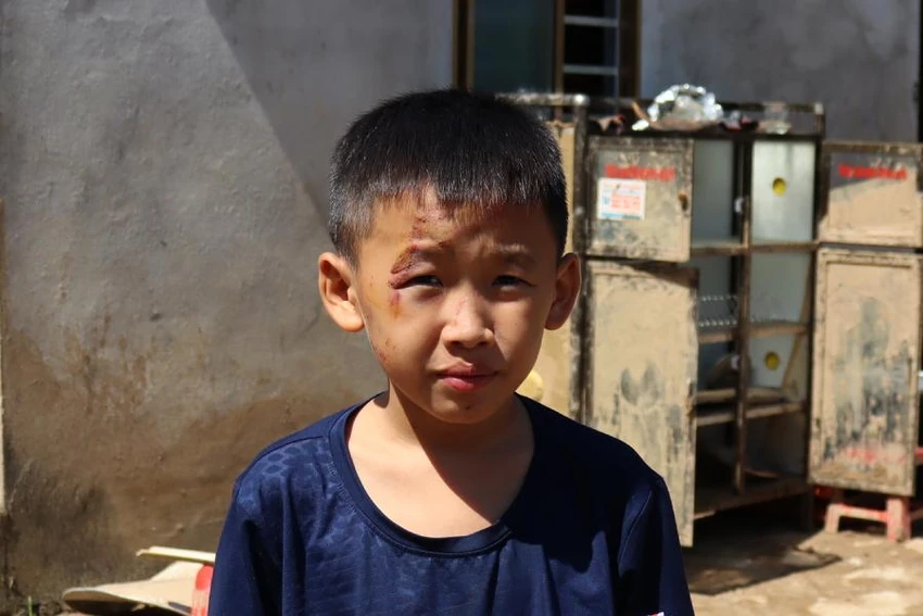 Trên mặt, chân, tay của cháu Mùa có nhiều vết thương do lũ cuốn trôi, chưa lành. Ảnh: ĐẮC LAM